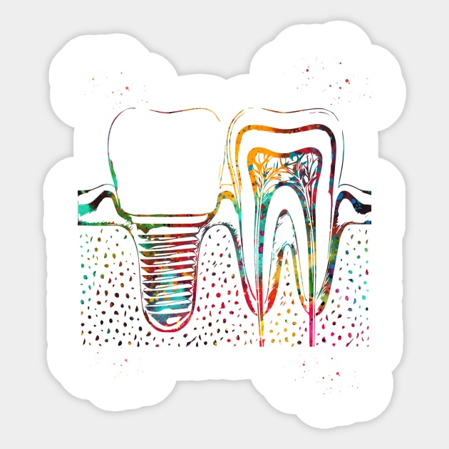 Human teeth and dental implant Sticker by erzebeth